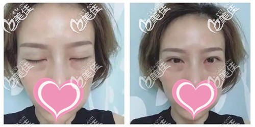 外切去眼袋手術(shù)后恢復(fù)三天照片 外切去眼袋手術(shù)后恢復(fù)三天照片