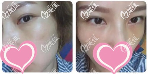 外切去眼袋手術(shù)一個(gè)月效果 外切去眼袋手術(shù)一個(gè)月效果