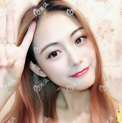 聽說佛山順德壹加壹是正規(guī)整形美容醫(yī)院,找肖鵬院長做完隆鼻后感覺果然靠譜