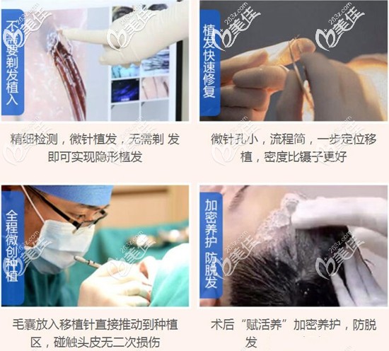 廣州華美先進(jìn)的毛發(fā)移植技術(shù) 廣州華美先進(jìn)的毛發(fā)移植技術(shù)