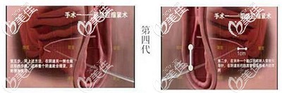 3d束帶緊縮手術(shù)的原理 3d束帶緊縮手術(shù)的原理