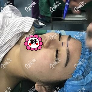 肋軟骨隆鼻修復(fù)術(shù)前設(shè)計(jì)