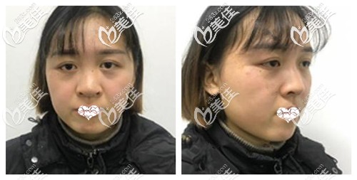 都說鼻綜合局麻生不如死 可是我做肋骨鼻術(shù)中和術(shù)后都沒有太大痛感