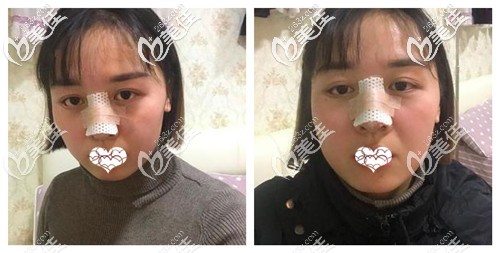 剛做完鼻綜合手術(shù)后的鼻子腫脹厲害 剛做完鼻綜合手術(shù)后的鼻子腫脹厲害