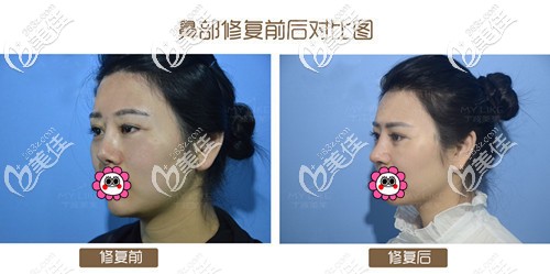 肋軟骨隆鼻術(shù)后對(duì)比效果圖二