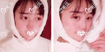 做完鼻綜合術(shù)后1個(gè)月鼻子基本恢復(fù) 做完鼻綜合術(shù)后1個(gè)月鼻子基本恢復(fù)