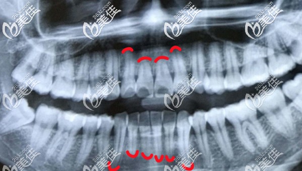 先天性牙根短小全景片示意圖 先天性牙根短小全景片示意圖
