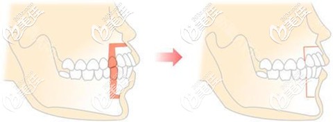 正頜手術(shù)治療原理