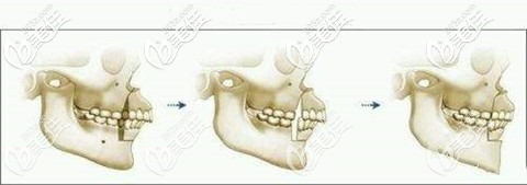 正頜手術(shù)過程