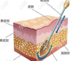 北京藝美王東吸脂手術(shù)過程示意圖