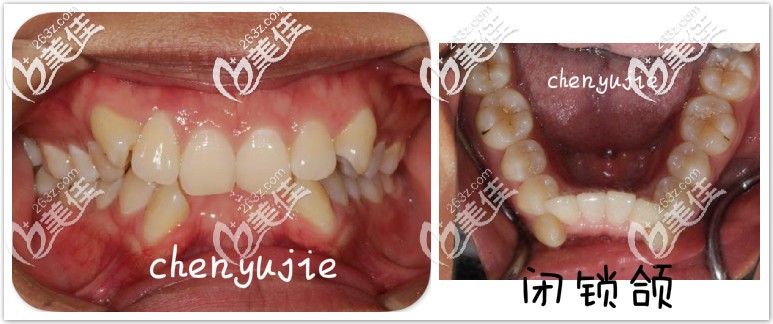 難道隱形牙套解決不了深覆合么？其實隱適美矯正閉鎖型深覆合臉型也有改善的