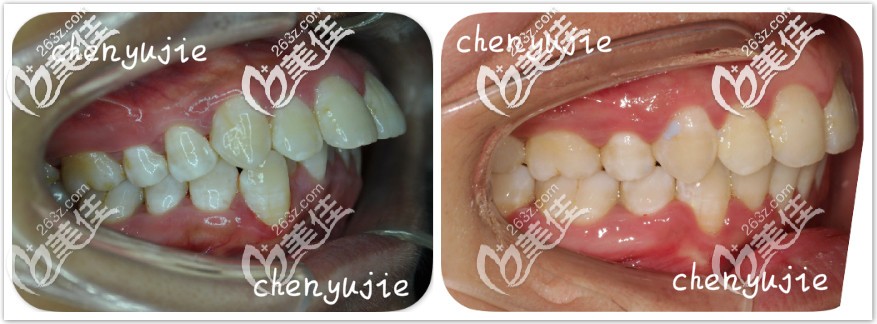 門(mén)牙外凸隱形矯正前后對(duì)比圖 門(mén)牙外凸隱形矯正前后對(duì)比圖