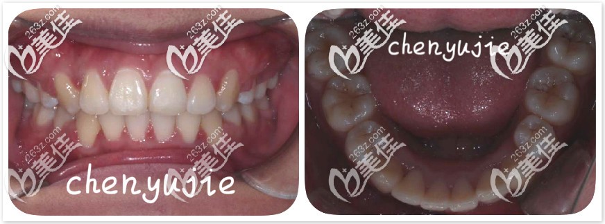 深覆合牙齒前后變化圖 深覆合牙齒前后變化圖
