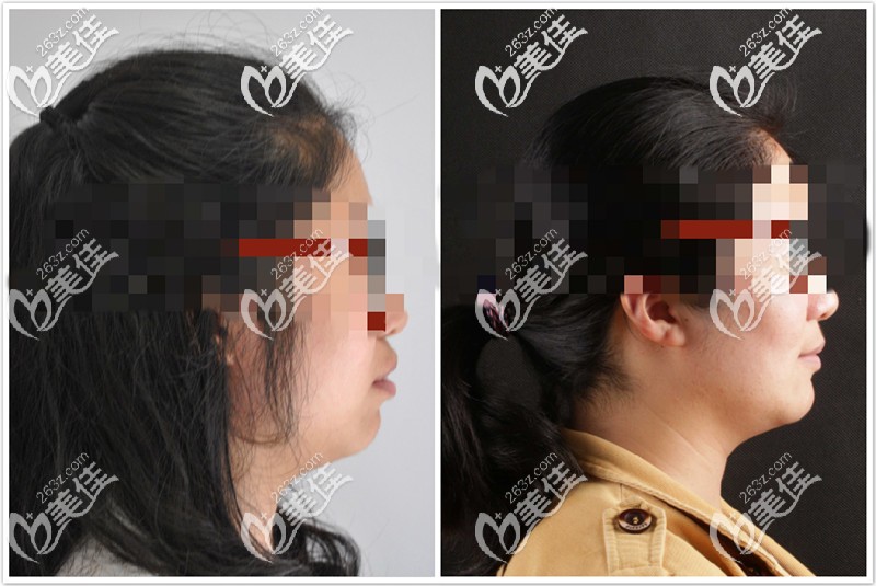 深覆合矯正后臉型也有改善 深覆合矯正后臉型也有改善