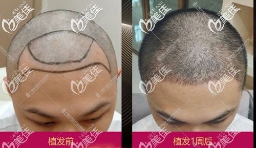 廣州華美發(fā)際線植發(fā)案例 廣州華美發(fā)際線植發(fā)案例