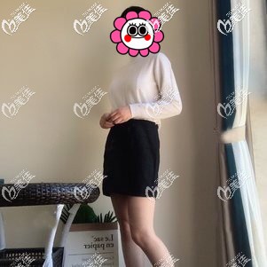 到寧波壹加壹做大腿吸脂恢復(fù)一個(gè)月 到寧波壹加壹做大腿吸脂恢復(fù)一個(gè)月