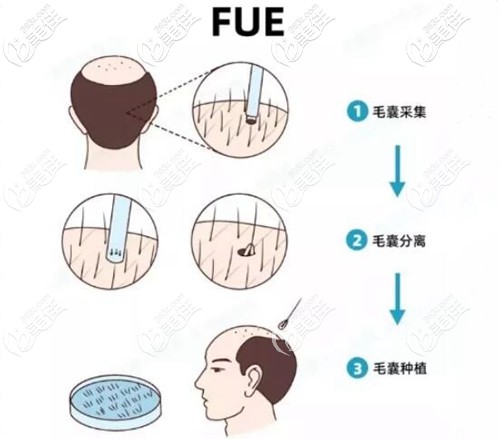 植發(fā)手術(shù)操作過程原理