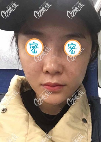 全臉埋線提升半個(gè)月的變化 全臉埋線提升半個(gè)月的變化
