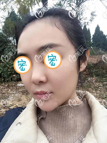 雖然不知道我法令紋埋線用了幾根,但從全臉提升效果來看效果還是不錯的