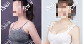 特貝茨隆胸真人案例:特貝茨隆胸3個(gè)月效果對(duì)比圖 特貝茨隆胸真人案例:特貝茨隆胸3個(gè)月效果對(duì)比圖