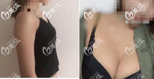 我做特貝茨隆胸3個(gè)月恢復(fù)效果給大家看 我做特貝茨隆胸3個(gè)月恢復(fù)效果給大家看