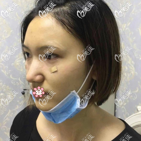 王方鵬祛眼袋術(shù)后3天