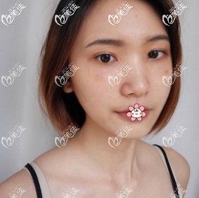 重慶藝星整形祛眼袋怎么樣