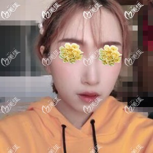 熱瑪吉美膚術(shù)后半個(gè)月效果照