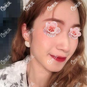 用我在長沙梵童做熱瑪吉全面部900發(fā)的親身經(jīng)歷來說下到底痛不痛！