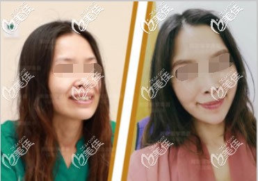 小切口全臉提升圖片 小切口全臉提升圖片