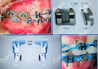 MBT直絲弓正畸技術(shù) MBT直絲弓正畸技術(shù)