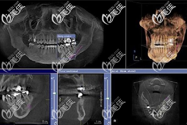 <!--<i data=20240703-sp></i>-->口腔全口種植牙CT片 <!--<i data=20240703-sp></i>-->口腔全口種植牙CT片