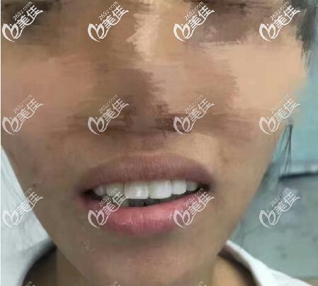 寧波小伙齲齒根管治療后戴了5顆威蘭德全瓷牙啥概念,價格便宜的烤瓷牙不推薦