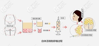 自體脂肪面部填充的原理 自體脂肪面部填充的原理