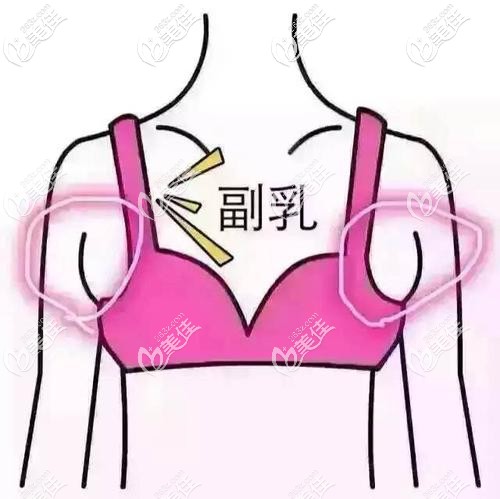 副乳的位置 副乳的位置