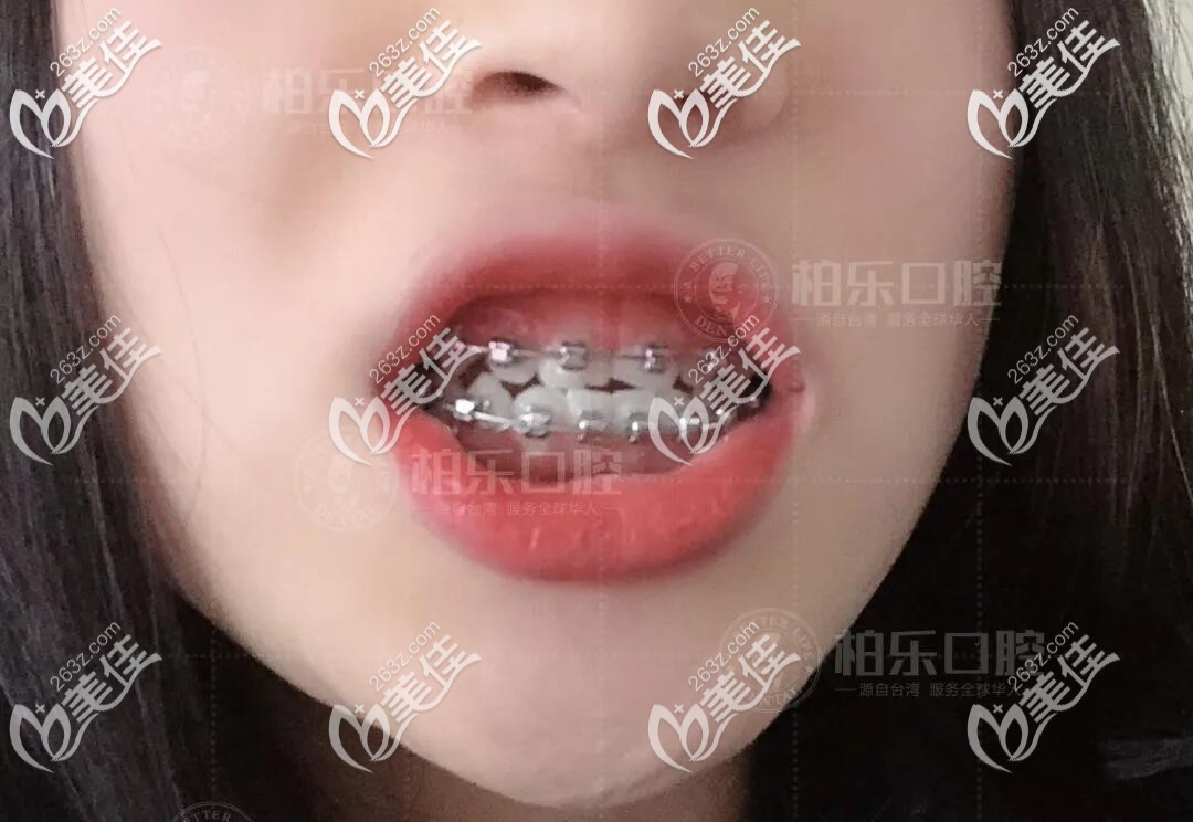 國產(chǎn)自鎖托槽矯正