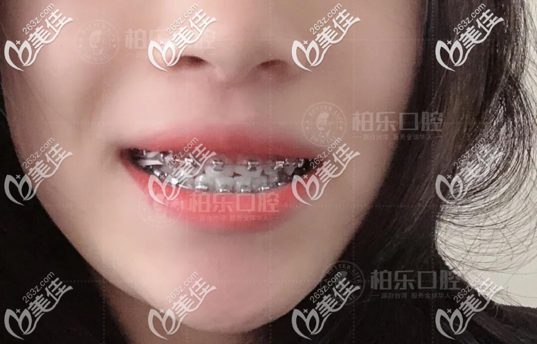 虎牙矯正中效果圖