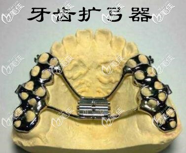 牙齒擴(kuò)弓器 牙齒擴(kuò)弓器