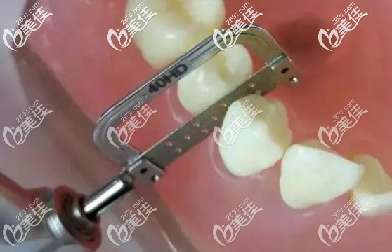 牙齒片切示意圖