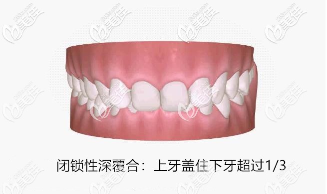 閉鎖性深覆合:上牙蓋住下牙超過1/3 閉鎖性深覆合:上牙蓋住下牙超過1/3