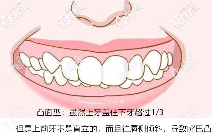 凸面型深覆合 凸面型深覆合