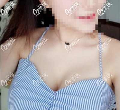 我做曼托水滴225cc假體隆胸直接變成C罩杯 我做曼托水滴225cc假體隆胸直接變成C罩杯