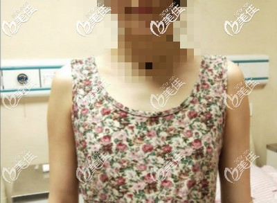 做曼托水滴225cc假體隆胸前圖片 做曼托水滴225cc假體隆胸前圖片