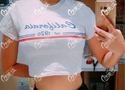 做曼托水滴225cc假體隆胸60天<span style= 做曼托水滴225cc假體隆胸60天<span style=