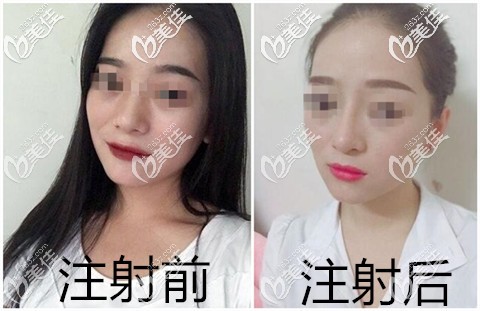 法思麗隆鼻注射效果 法思麗隆鼻注射效果