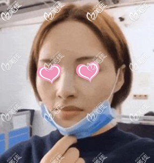 超體隆鼻術(shù)后當(dāng)天照