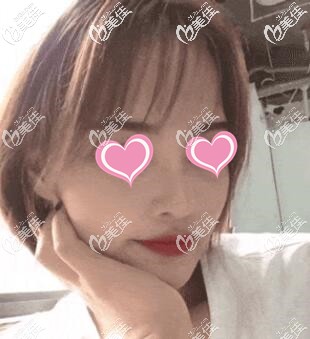 超體隆鼻術(shù)后14天照片