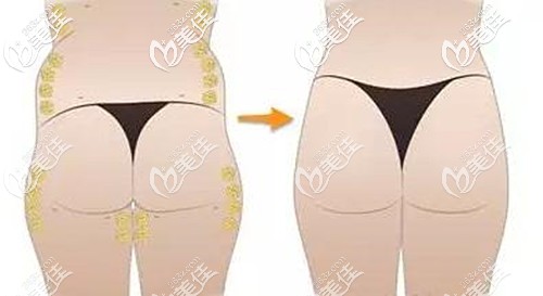 假胯寬的表現(xiàn) 假胯寬的表現(xiàn)