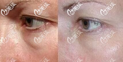 熱瑪吉眼周治療效果對比照 熱瑪吉眼周治療效果對比照