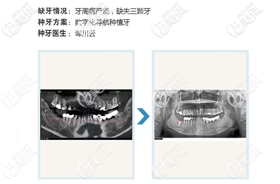 柏樂口腔種植牙案例 柏樂口腔種植牙案例